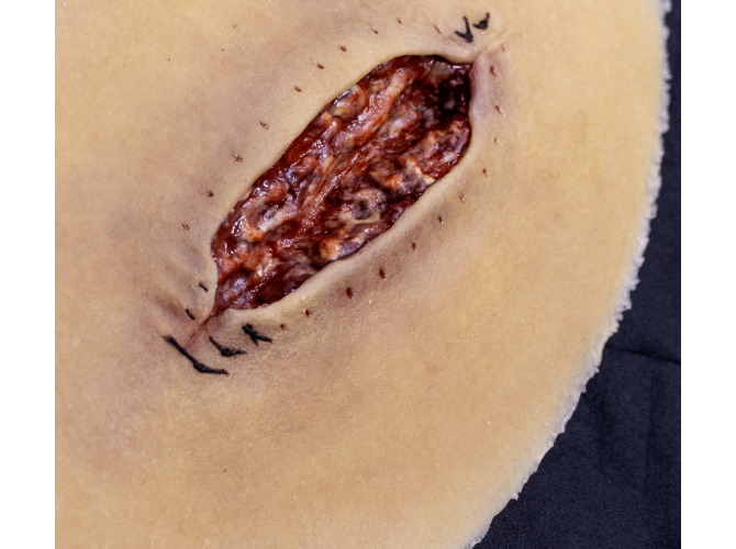 CS014-Surgical_dehiscenceMedium