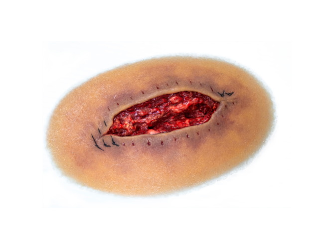 CS014-ClinicalWound_dehiscenceMedium