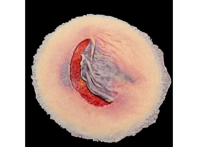 CS009_ClinicalWound_1SkinTear-LT-2